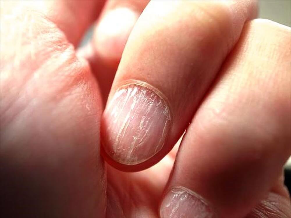 phong-ngua-benh-nam-mong