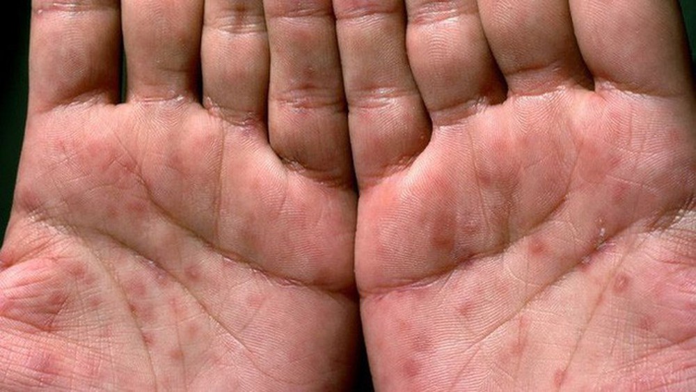 cach-tri-benh-giang-mai